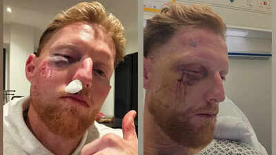 Ben Stokes undergoes facial surgery after freak nets blow, England captain shares pic | Cricket News