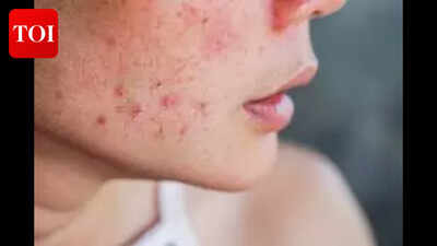 Why your acne scars won’t go away — science finds the real reason | India News