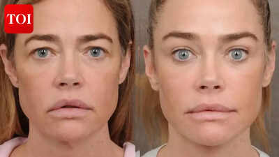 Denise Richards opens up about facelift; surgeon hails actress for bravely sharing ‘before and after’ pics of work done on forehead, eyes, mouth, neck |