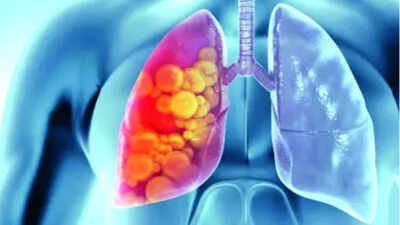 Lung cancer deaths down 16% with low-dose CT screening: IARC | India News